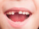 RFK Jr’s plan to ban fluoride supplements will “hurt rural America,” dentists say